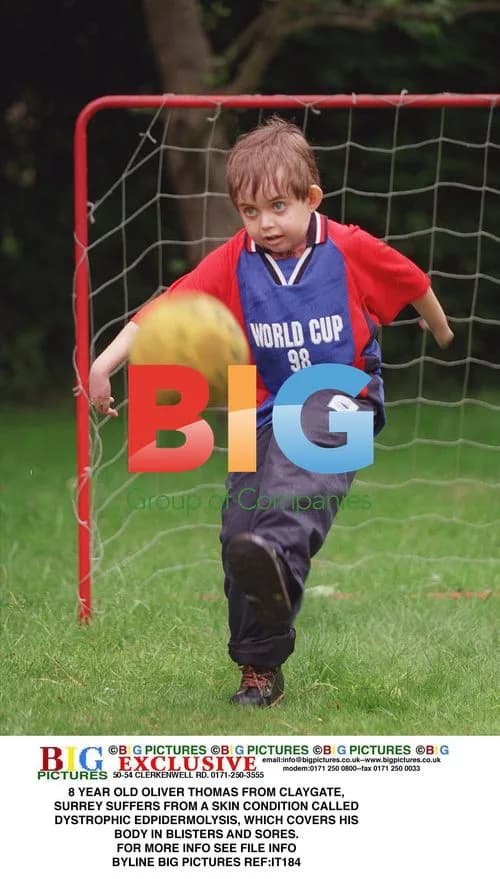 8 Year Old Oliver Thomas Overcomes Skin Condition
