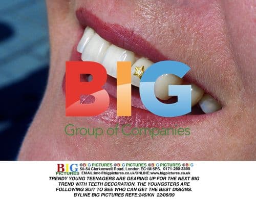 Teens Decorate Teeth for Trends