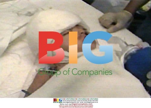 Conjoined Twins Separated in LA