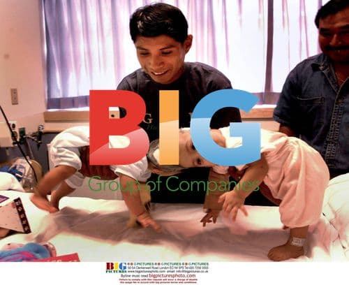 Guatemalan Twins Separated at UCLA