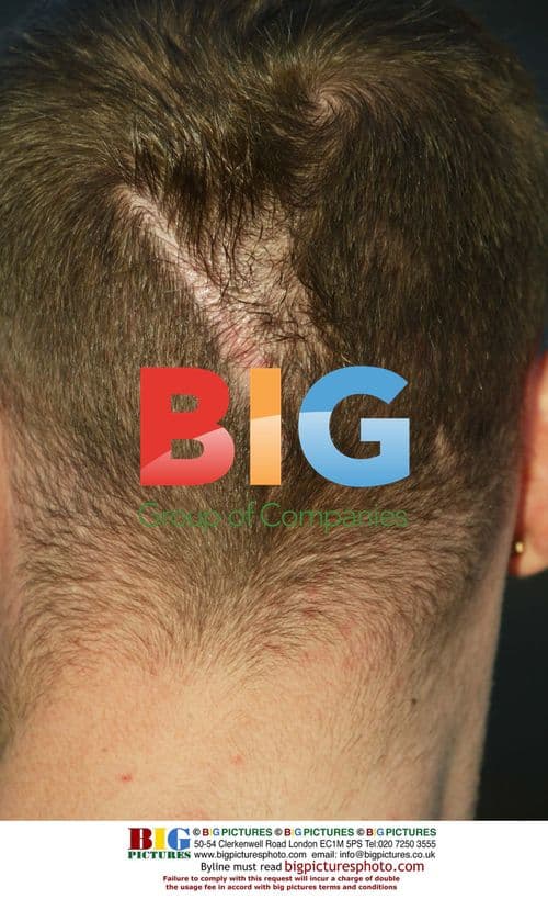 Brian Harvey's Head Scar