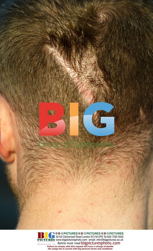 Brian Harvey's Head Scar