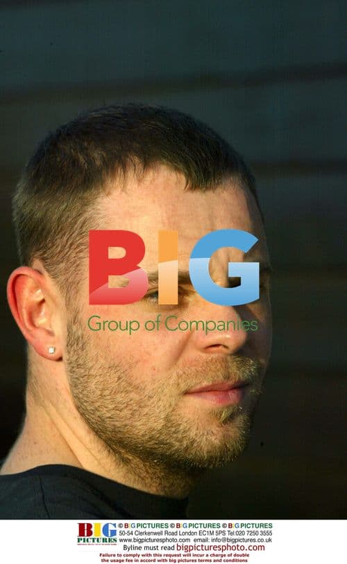 Brian Harvey's Head Scar