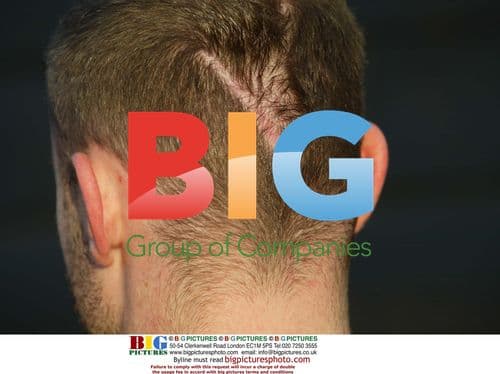 Brian Harvey's Head Scar