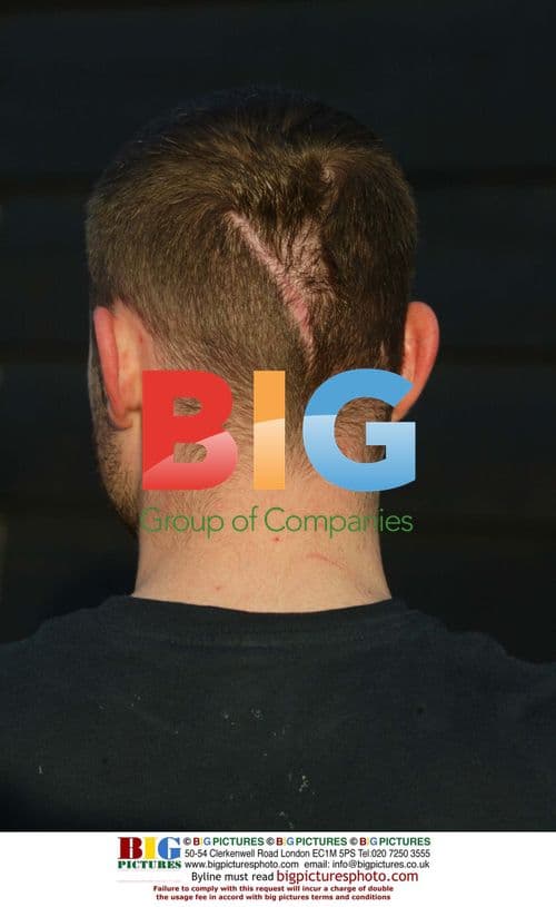 Brian Harvey's Head Scar