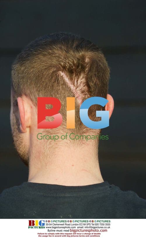 Brian Harvey's Head Scar