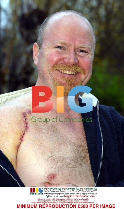 EastEnders' Steve McFadden's Injured Shoulder