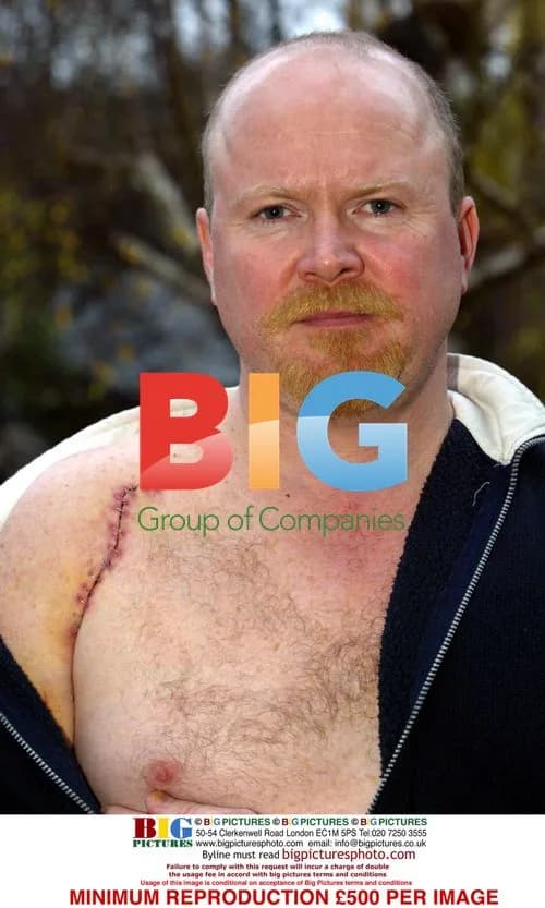 EastEnders Star Steve McFadden's Injured Shoulder