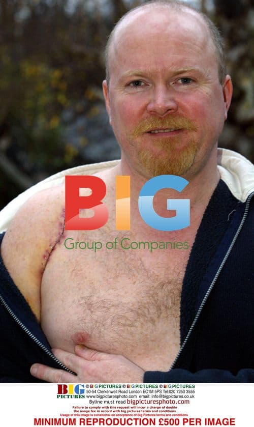 Steve McFadden's Shoulder Surgery