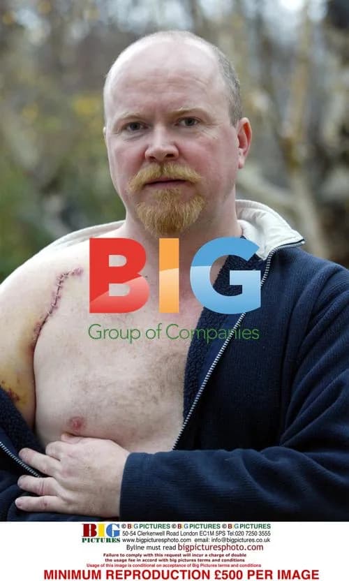 Steve McFadden's Injured Shoulder