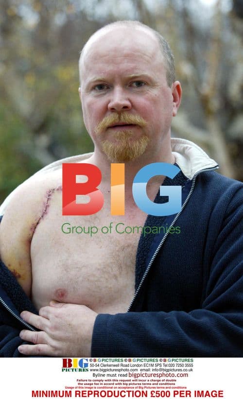 EastEnders Star Steve McFadden's Shoulder Surgery