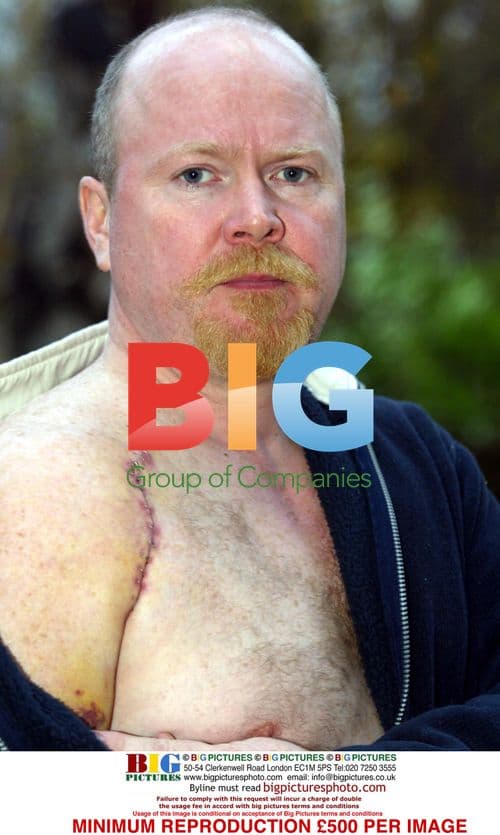 EastEnders Star Steve McFadden's Injured Shoulder