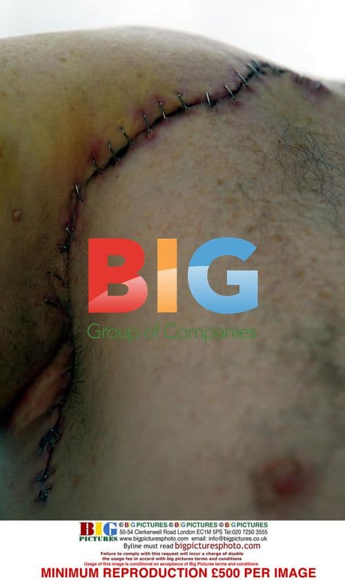 EastEnders' Steve McFadden Injured Shoulder