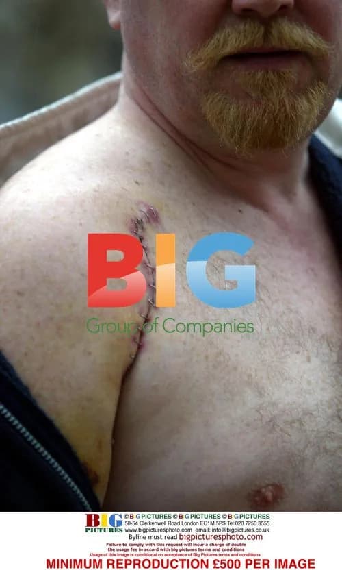 Steve McFadden\'s Shoulder Injury