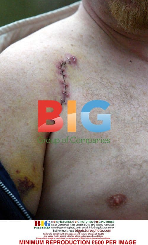 EastEnders' Steve McFadden Recovers From Shoulder Injury