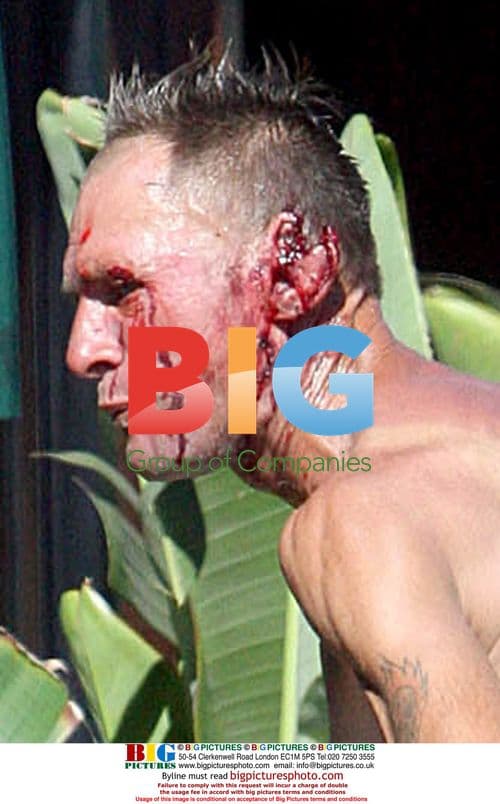 Shirtless man with injured ear in West Hollywood