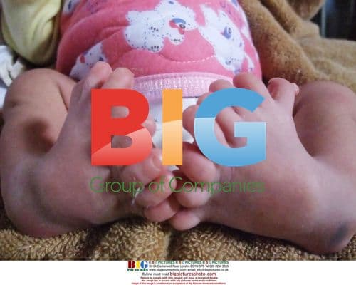 Woman gives birth to baby with 16 toes