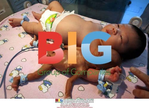 Prematurely Born Baby Survives in China