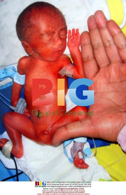 Premature baby born at 600 grams survives in China