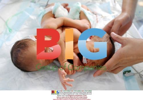 Conjoined twins born in China