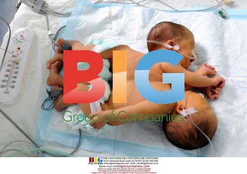 Conjoined Twins Born in China Hospital