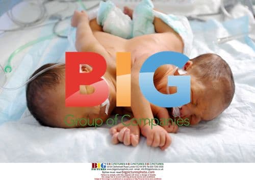 Conjoined Twins Born in China