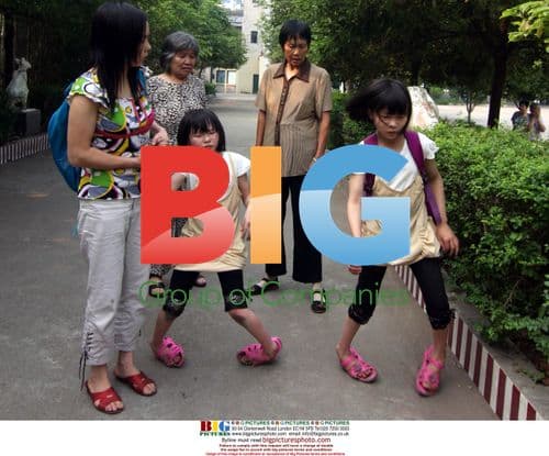 Twin sisters struggle with leg deformities in China