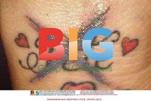 Katie Price Removes Peter Andre Tattoo