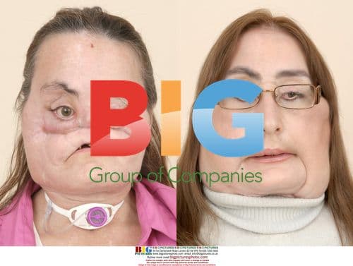 Connie Culp Face Transplant