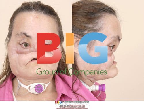 Face Transplant Patient Connie Culp